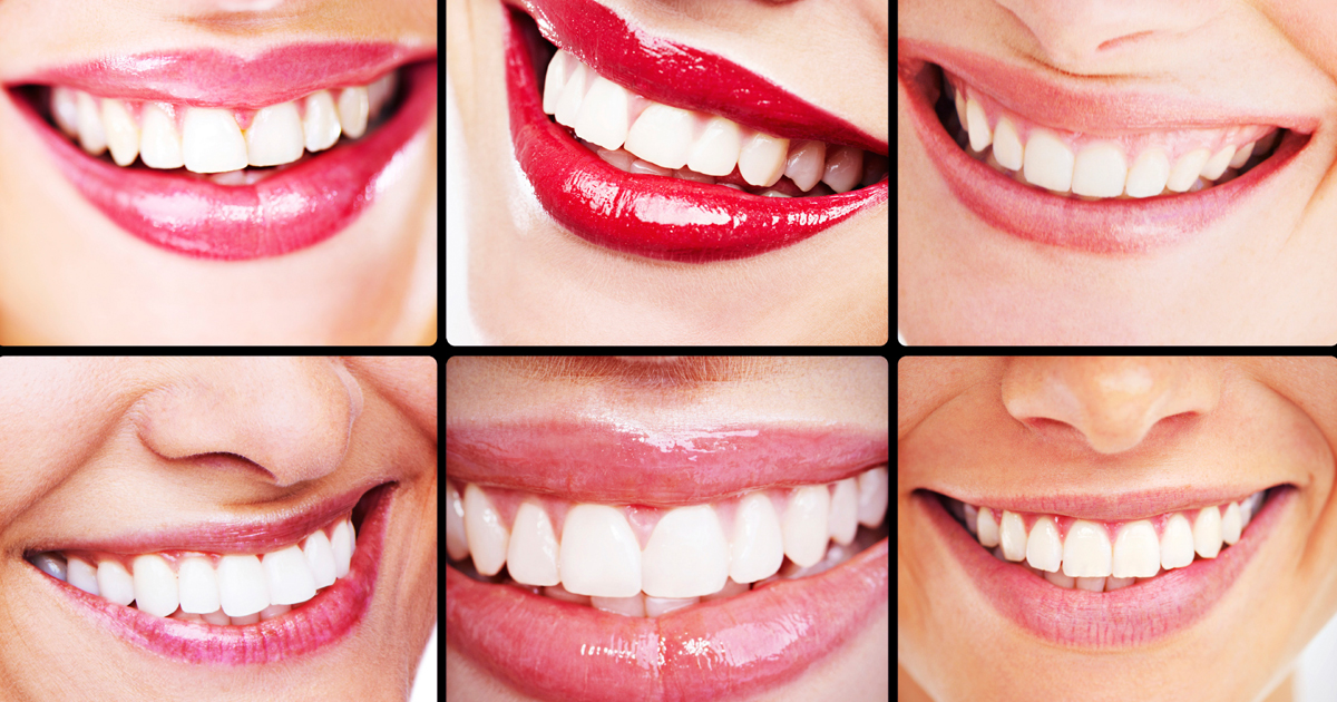 dca-blog_article-38_crowns-veneers-lumineers_1200x630