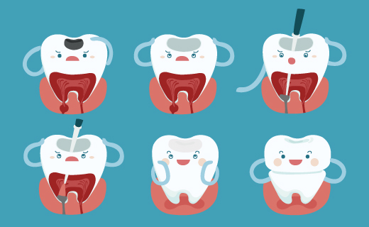 dca-blog_article-04_overview-of-root-canals