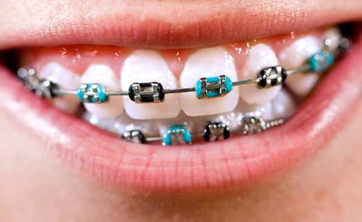 dca-blog_how-to-care-for-your-braces